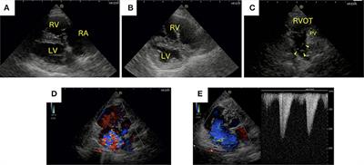 Case Report: Tricuspid Annuloplasty for Right-Sided Congestive Heart Failure Secondary to Pulmonary Hypertension in a Dog